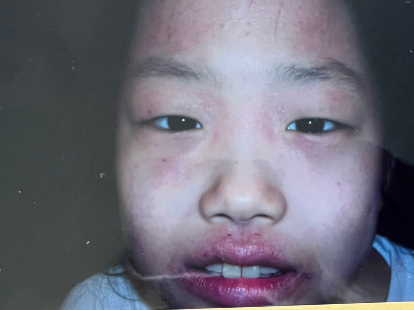 Remi — Eczema 101